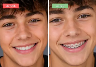 braces results boy by ai smile simulator