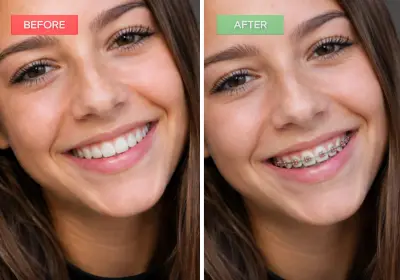 braces results girl by ai smile simulator